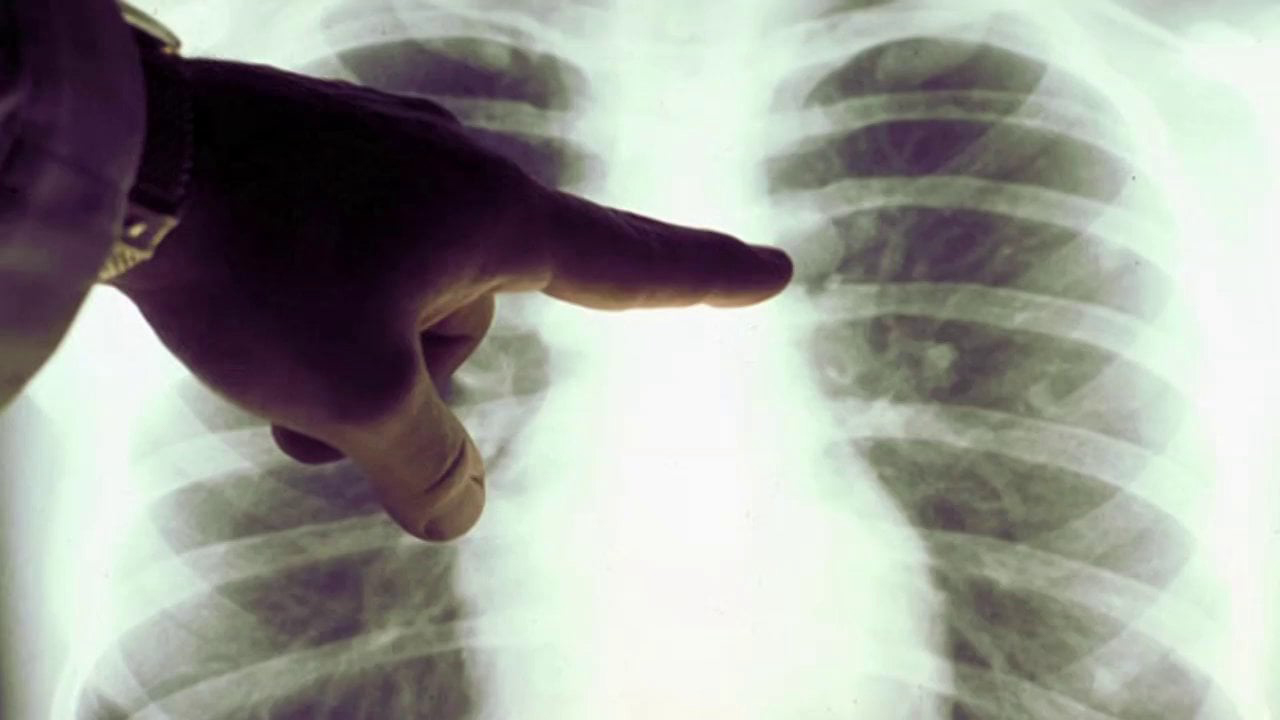 Xray of lung cancer